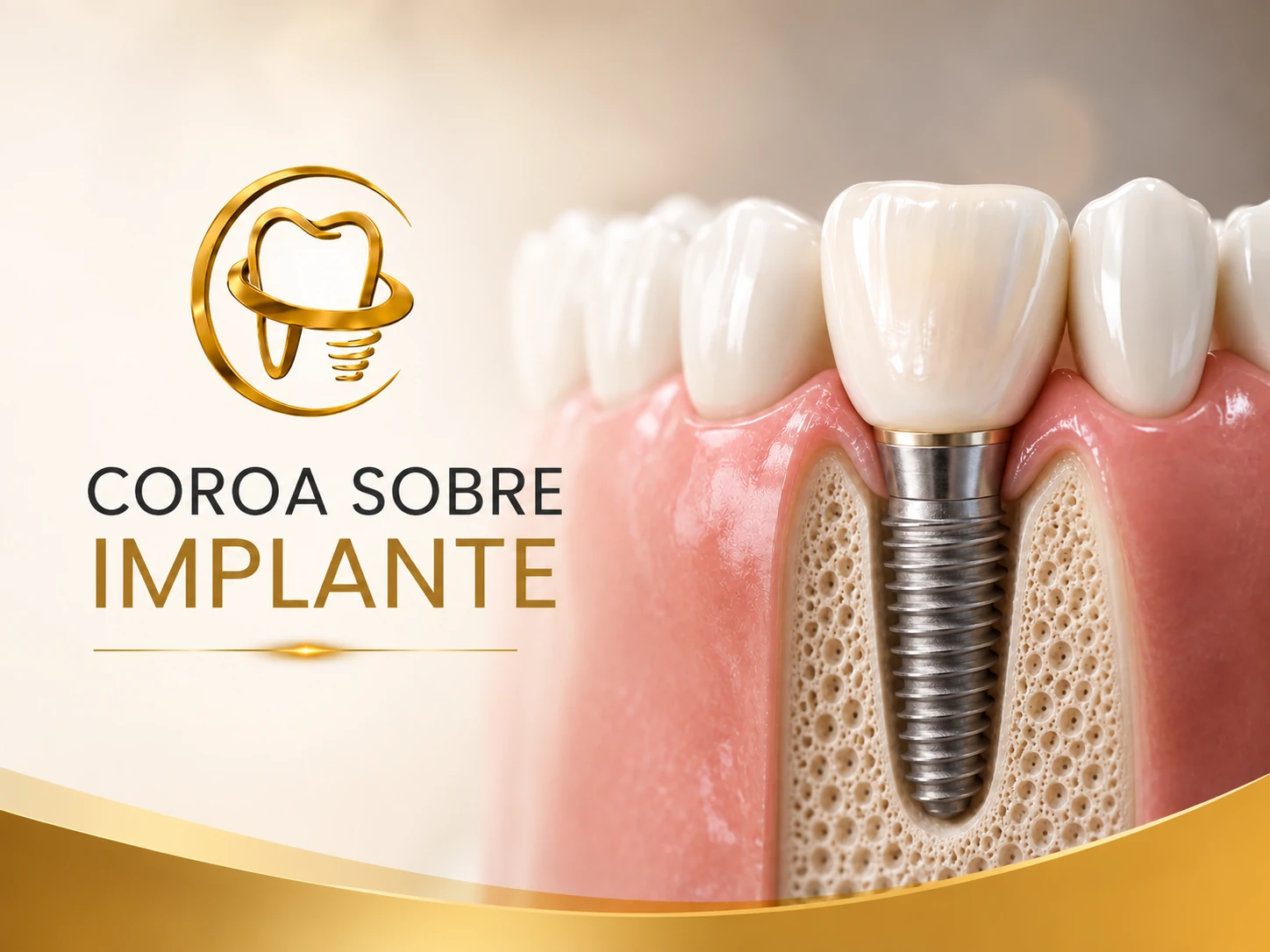 Representação de Coroa sobre Implante na Odonto Plenna em Florianópolis