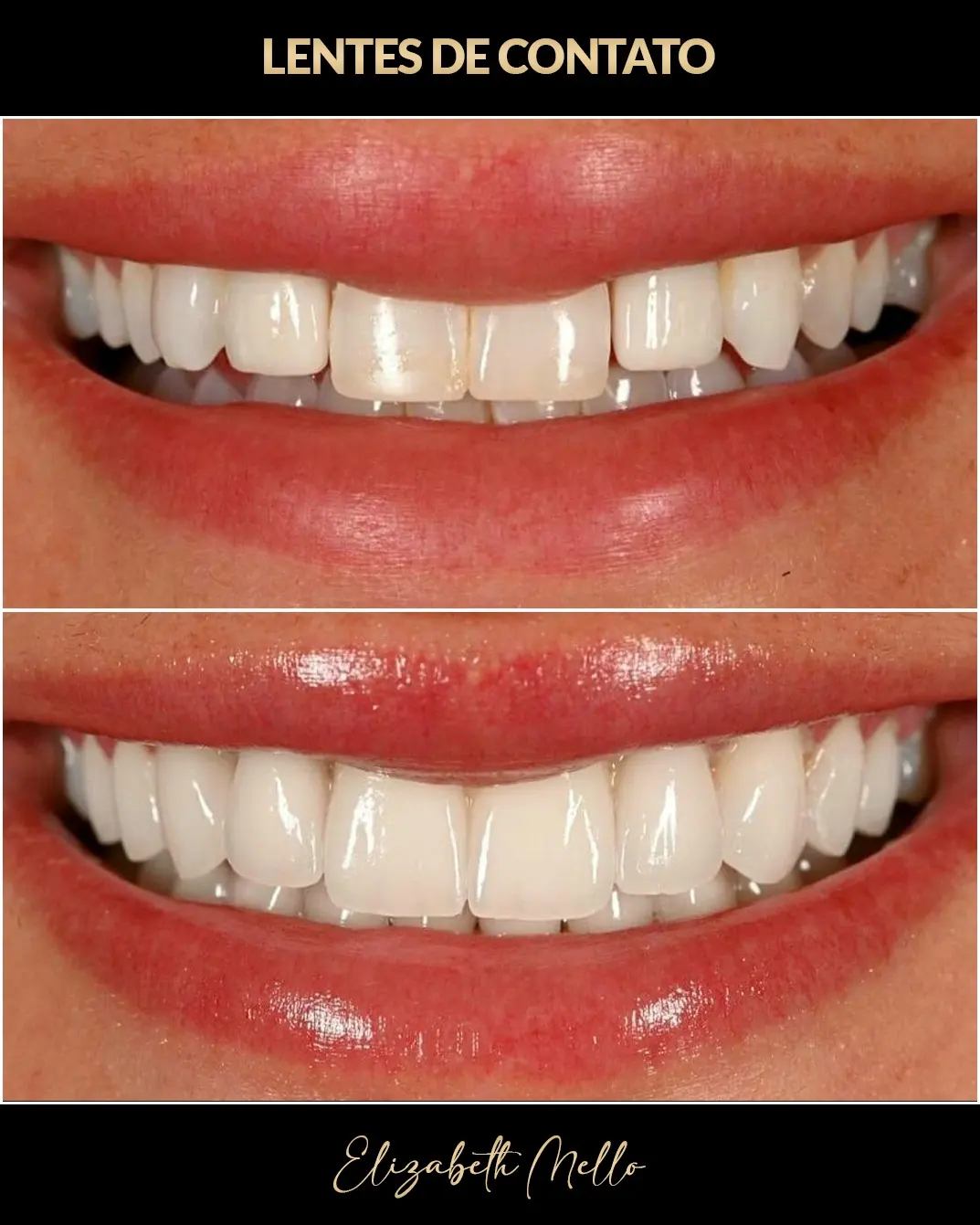 Antes e depois de lentes de contato dental em caso clínico real