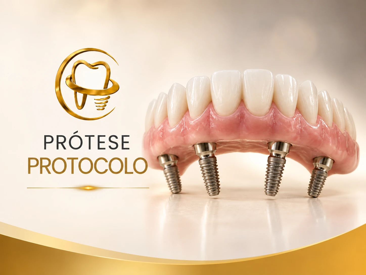 Representação de Prótese Protocolo na Odonto Plenna em Florianópolis